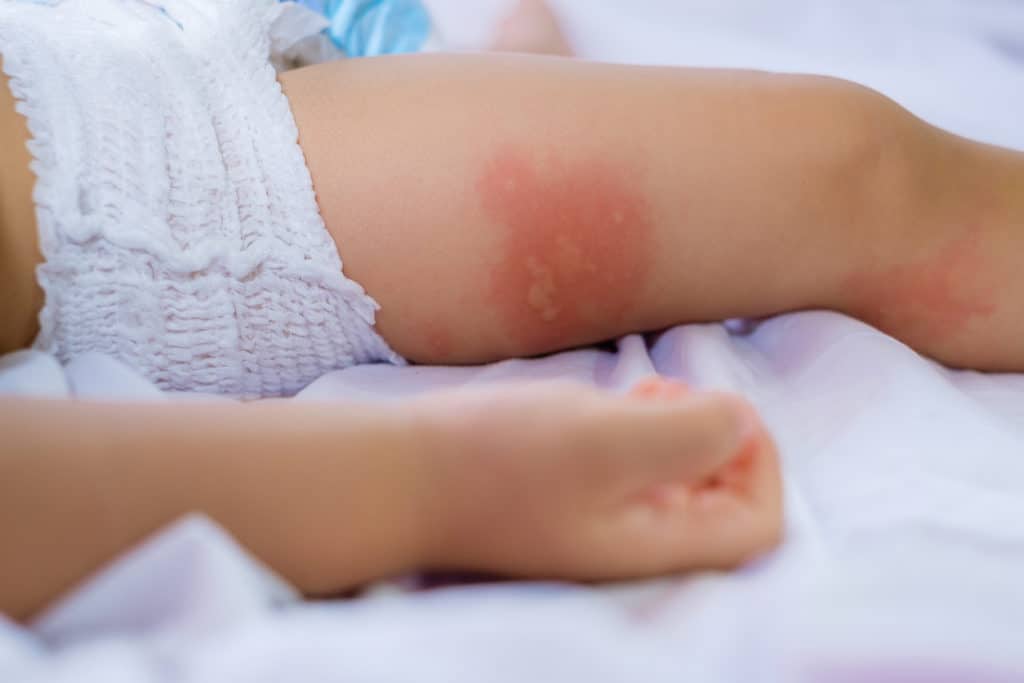 Leg of sleeping Small child with redness on the skin, suffering from food allergies